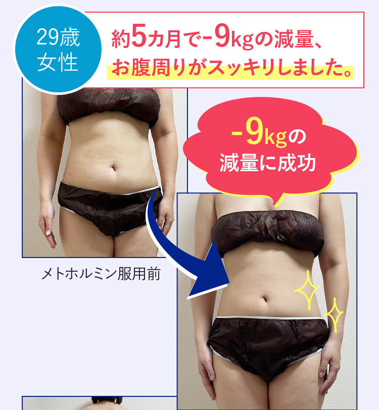 29歳女性 約5ヵ月でー9kgの減量、お腹周りがスッキリしました。 メトホルミン服用前 ー9kgの減量に成功