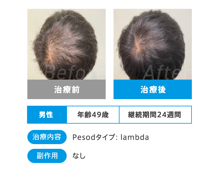 Before After 治療前 治療後 男性 年齢49歳 継続期間24週間 治療内容 Pesodタイプ:lambda 副作用 なし
