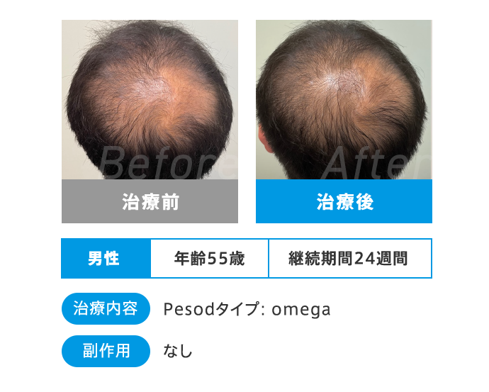 Before After 治療前 治療後 男性 年齢55歳 継続期間24週間 治療内容 Pesodタイプ:omega 副作用 なし