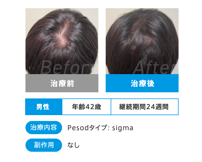 Before After 治療前 治療後 男性 年齢42歳 継続期間24週間 治療内容 Pesodタイプ:sigma 副作用 なし