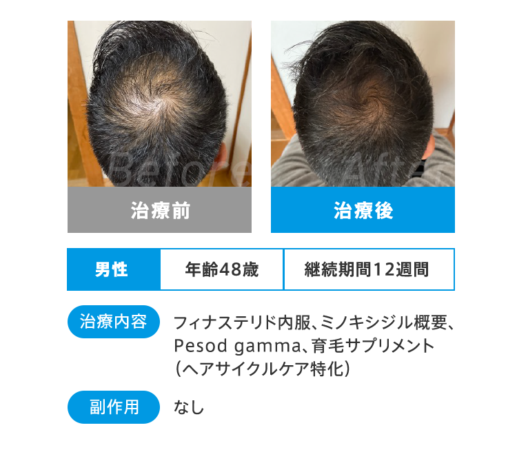 Before After 治療前 治療後 男性 年齢48歳 継続期間12週間 治療内容 フィナステリド内服、ミノキシジル概要、Pesod gamma、育毛サプリメント(ヘアサイクルケア特化) 副作用 なし