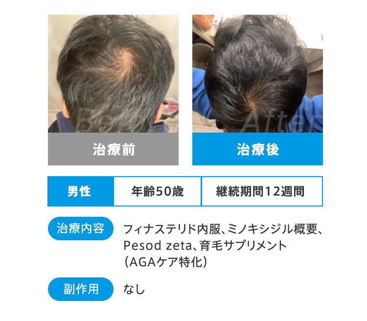 Before After 治療前 治療後 男性 年齢50歳 継続期間12週間 治療内容 フィナステリド内服、ミノキシジル概要、Pesod zeta、育毛サプリメント（AGAケア特化） 副作用 なし