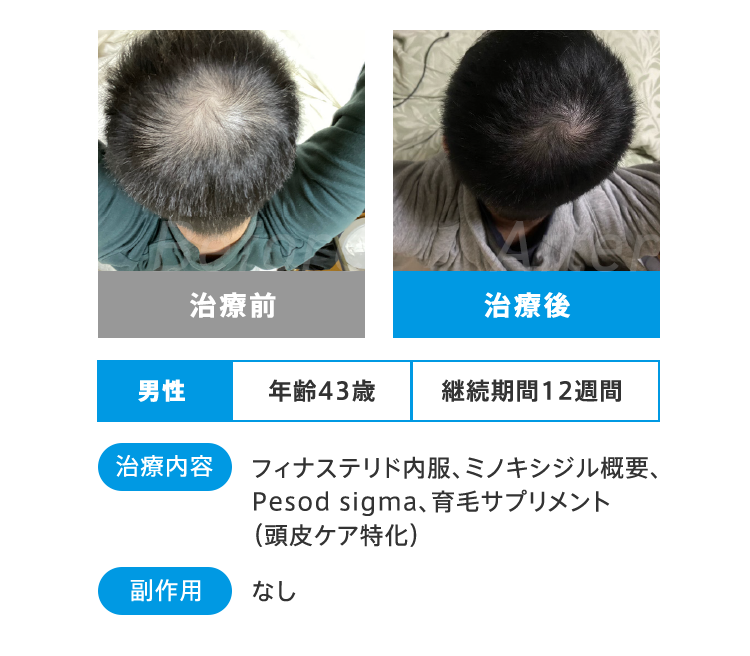 Before After 治療前 治療後 男性 年齢43歳 継続期間12週間 治療内容 フィナステリド内服、ミノキシジル概要、Pesod sigma、育毛サプリメント頭皮ケア特化）副作用 なし